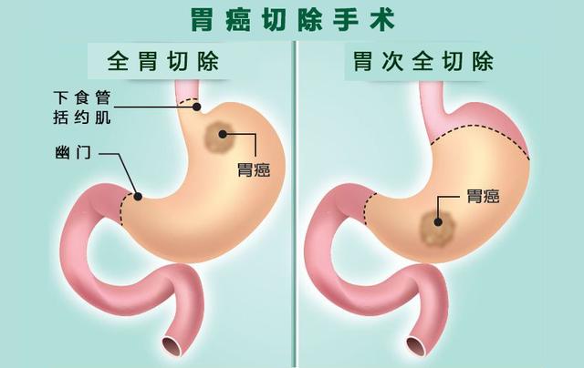 全胃切除术后记得补充维生素B12，当心贫血找上门