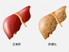 不抽烟喝酒，没有肝炎为什么会得肝硬化？