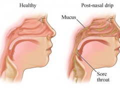 【症状】鼻涕反流Nose reflux