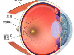 “畏光”可能是黄斑变性，吃叶黄素有用吗？